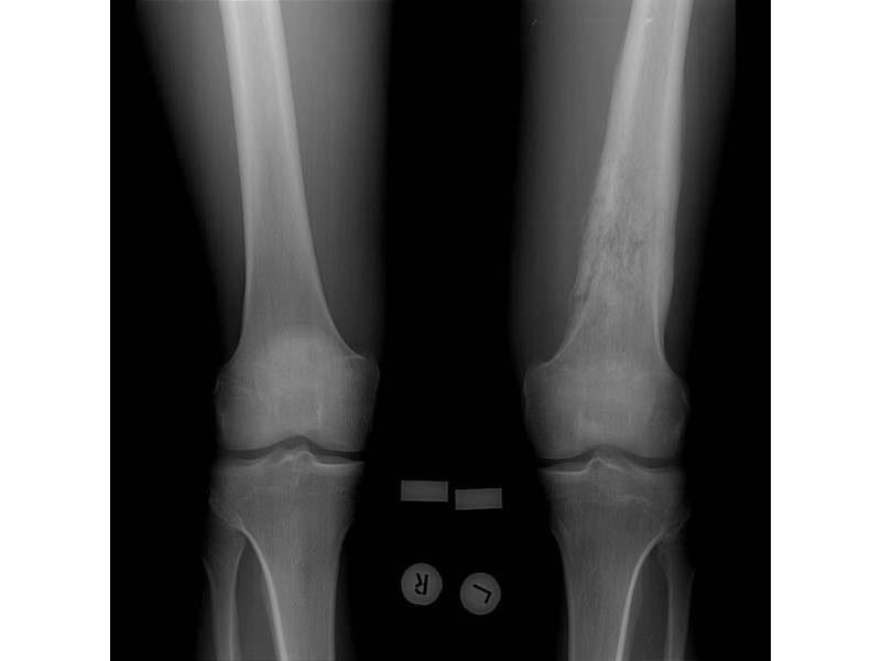 Ренгенологические признаки диафиз длинной трубчатой кости распространение длиннику кости мелкоочаговая, по сливная литическая деструкция